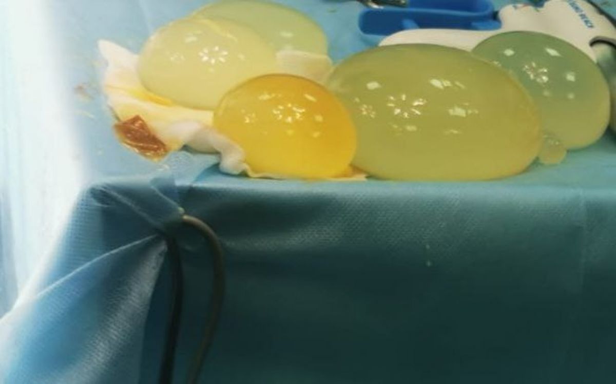 Хирурги избавили туляка от гигантского эхинококкоза брюшной полости