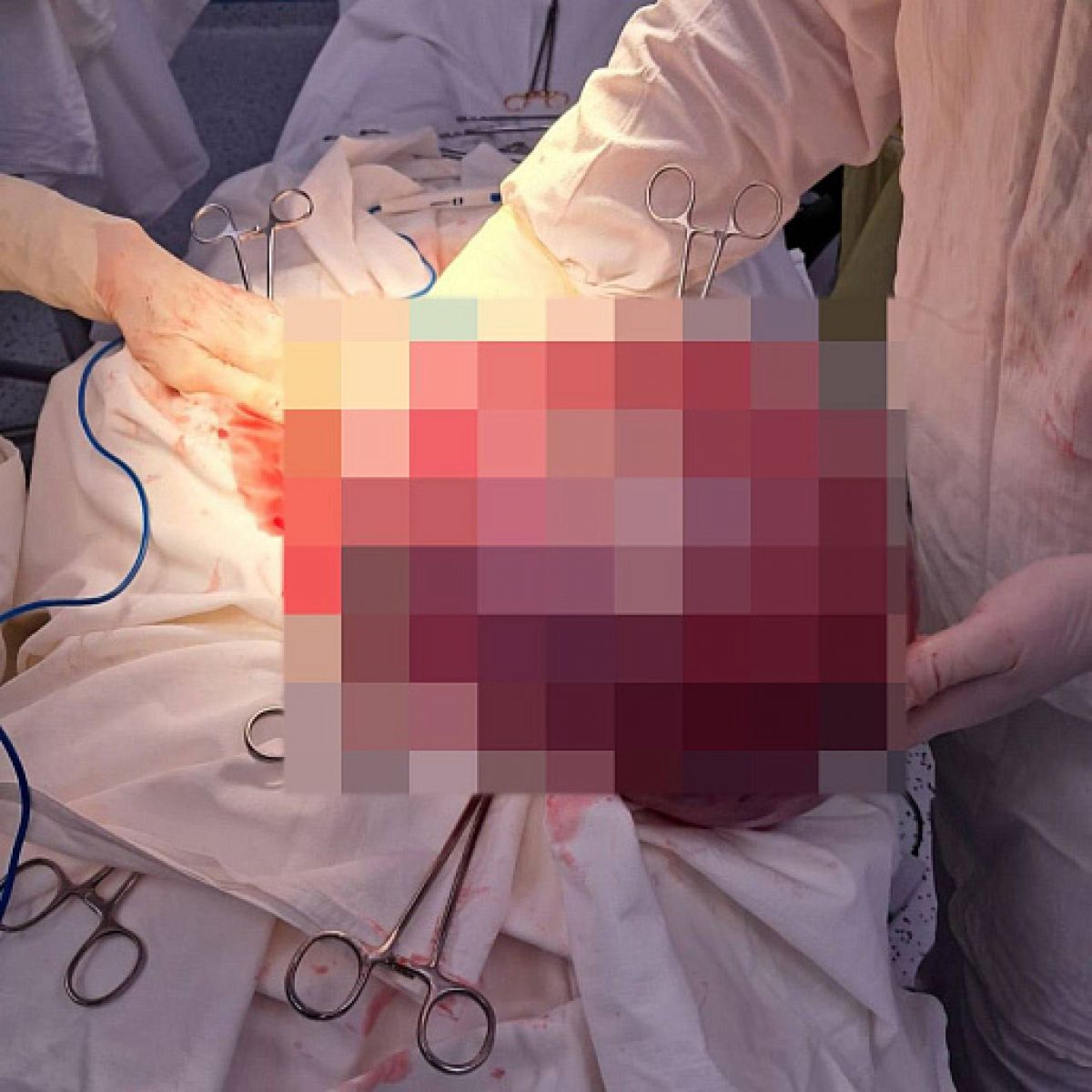 Опухоль размером с арбуз удалили онкологи у тулячки Опухоль размером с арбуз удалили онкологи у тулячки