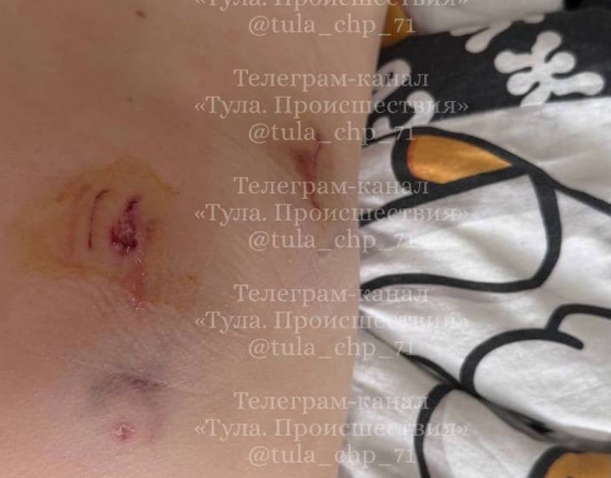 В Тульской области на 7-летнюю девочку напали две собаки В Тульской области на 7-летнюю девочку напали две собаки