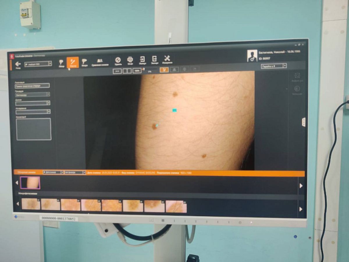 Туляков проверили на меланому